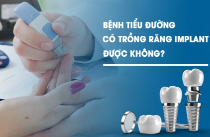Cấy Ghép Implant Cho Người Bị Tiểu Đường: Những Điều Cần Biết